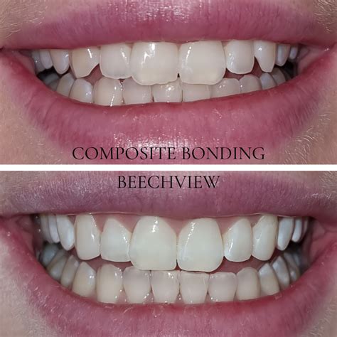 dental bonding burnsville mn|Dental Bonding, Cosmetic Dentist, Dentist Burnsville, MN.